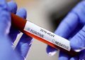 Studi; Pasien Covid-19 Bisa Pulih dengan Plasma Darah Pasien yang Telah Sembuh