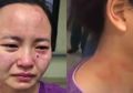 Niat Hati Ingin Sembuhkan Pasien Covid-19, Perawat ini Malah Dicakar, Digigit, hingga Timbulkan Luka Lebam di Wajahnya, Ngilu!