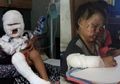 Sekujur Tubuhnya Terbakar Gara-gara Botol Handsanitizer, Balita Mungil Ini Justru Ditolak Rumah Sakit, Main-main di Dekat Tempat Sampah Buatnya Terluka Parah