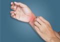 Manfaat Puasa Bagi Penderita Penyekit Kulit, Redakan Dermatitis Kontak Sampai Eksim