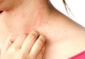 10 Obat Gatal Alami Pada Kulit Paling Ampuh Ini Pasti Ada di Rumah!