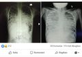 Meski Anda Sudah Terjangkit Corona dan Kemudian Sembuh, WHO Sebut Belum Ada Bukti Anda Bisa Kebal dari Covid-19