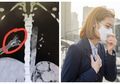 Tersiksa Batuk Parah Selama 14 tahun, Seorang Wanita 22 Tahun Akhirnya Mengetahui Penyebabnya yang Tak Terduga, Padahal Sudah Periksa Berkali-kali Tapi Keberadaan Benda Ini Justru Terdeteksi 'Tanpa Sengaja'