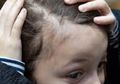 Waspadai Rambut Rontok Pada Anak Akibat Gangguan Penyakit Alopecia Areata