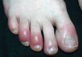Sejumlah Pasien Covid Alami Ruam di Kaki, Mungkinkah Jadi Gejala Baru Virus Corona?