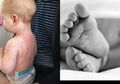 Alami Ruam di Sekujur Tubuhnya, Bayi 8 Bulan Ini Meninggal Karena Penyakit Kawasaki, Dokter Duga Juga Terkait Virus Corona