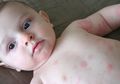 Ini Obat Biduran untuk Bayi: Tempatkan di Ruangan yang Dingin