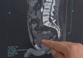 Gara-gara Kebanyakan Minum Minuman Ini, Seorang Pria Kandung Kemihnya 'Meledak', Dokter Ungkap Penyebabnya Seringkali Kita Lakukan