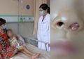 Gara-gara Tersandung dan Jatuh, Bocah ini Ngeluh Susah Bernapaas, Setelah Diperiksa Dokter Temukan ini di Hidungnya