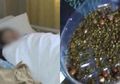 Horor! Wanita yang Sering Begadang dan Tak Pernah Sarapan serta Kurang Minum Air Putih Mengeluh Sakit, Dokter Syok Temukan Ribuan Batu Empedu di Tubuhnya