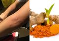 Obat Biduran Rumahan yang Mudah Didapat Bahkan Ada di Dapur Kita