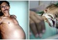 Melawan Hukum Alam, Pria Tulen Ini 'Hamil' Awalnya Dokter Mengira Isinya Tumor Setelah Dibedah Ternyata Isinya Manusia, Kisahnya Sulit Dinalar Akal Sehat