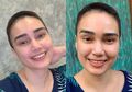 Berjuang Lawan Kista Ovarium, Feby Febiola Curhat soal Rambut yang Nyaris Botak Akibat Kemoterapi: Bukan Perjalanan yang Mudah Buat Aku
