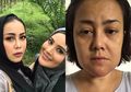 Jadi Korban Malpraktik Klinik Kecantikan, Wajah Rency Milano Turun ke Bawah, Bibir dan Dagu Kakak Elma Theana Keluarkan Nanah dan Mengeras