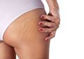 Daripada Krim Berbahaya, Ada 5 Obat Stretch Mark Alami yang Ampuh Bikin Kulit Jadi Mulus Lagi!