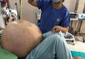 Membuat Dokter 'Terkejut Setengah Mati', Wanita Ini Miliki Tumor Ovarium Raksasa Terbesar di Dunia, Begini Kisah Diangkatnya Tumor Seberat 49Kg Itu