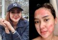 5 Tahun Idap Penyakit Serius, Cita Citata Akhirnya Dioperasi, Begini Kondisinya Sekarang