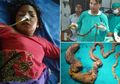 Ada Gumpalan Rambut Seberat 7 Kg di Dalam Perut Remaja 17 Tahun Ini, Ternyata Dia Idap Kondisi Langka yang Membuatnya Makan Rambutnya Sendiri