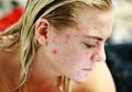 Jangan Dulu Pakai Skincare Mahal, Coba Gunakan Air Mawar pada Wajah dengan Cara Seperti Ini untuk Atasi Jerawat