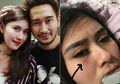 Syahnaz Sadiqah Tiba-Tiba Unggah Foto Menangis dan Tunjukkan Lebam di Bagian Bawah Mata, Ada Apa?