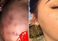 Potret Perubahan Drastisnya Bikin Takjub, Jerawat Kistik Wanita Ini Hilang Hanya dengan Perawatan Teh Hijau, Begini Caranya