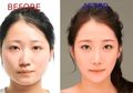 Benarkah Semakin Cantik? Ini 6 Operasi Plastik yang Paling Terkenal dan Sering Dilakukan di Korea Selatan