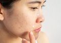 3 Solusi Hindari Jerawat Akibat Setiap Hari Menggenakan Masker
