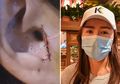 Mencoba Lakukan Operasi Plastik agar Hidung Terlihat Lebih Mancung, Wanita Ini Kaget saat Melihat ke Cermin, Ada Apa?