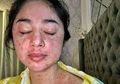 Setelah sembuh dari Covid-19, Dewi Perssik Alami Ruam Kemerahan di Wajah dan Seluruh Tubuh