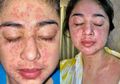 Satu Keluarga Positif Covid-19, Kenali Ruam Kulit Gejala yang Dialami Dewi Perssik!