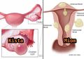 Beda Kista dan Miom, Gangguan Tumor Jinak Pada Organ Reproduksi Wanita
