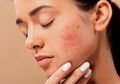 Cara Menghilangkan Bekas Jerawat dengan Mudah, 7 Obat Alami Ini Bisa Jadi Masker Rumahan