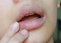 Lakukan Hal Ini Sebagai Obat Alami Mengatasi Bibir Kering, Begini Caranya