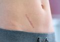 Bukan Hanya Bawang Putih, Begini Cara Menghilangkan Keloid dengan Bermodalkan Bahan Alami Ini Tanpa Perlu Operasi