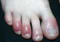 Awas Covid-Toes, Timbul Gejala Ruam Kemerahan di Kaki Pada Pasien Covid-19