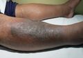 9 Komplikasi Diabetes Ini Bisa Melumpuhkan dan Mengancam Jiwa, Hati-hati