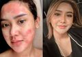 Selama Ini Suntik Putih dan Gunakan Produk Kimia, Cita Citata Kabarkan bahwa Dirinya Tengah Jalani Pengobatan Gegara Idap Autoimun