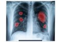 Tanda Paru-paru Terkena Penyakit Infeksi Pneumonia, Ini Ciri-cirinya