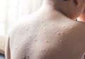 7 Penyakit Infeksi Kulit Pada Anak, Penyebabnya Kebanyakan Bakteri