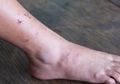 Bukan Hanya Kadar Gula Meningkat, Diabetes Juga Merusak Kulit
