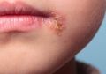 Impetigo, Infeksi Kulit Menular Pada Anak, Begini Cara Mencegahnya