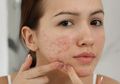 5 Tips Perawatan Kulit Kombinasi Agar Kulit Wajah Tetap Glowing!