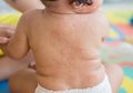 Gejala Infeksi Roseola yang Sering Terjadi Pada Bayi, Orangtua Perlu Tahu