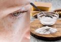 Tak Usah Memaksakan Diri Perawatan di Klinik Kalau Tidak Ada Biaya, Bikin Wajah Kembali Cerah Tanpa Flek Hitam Ternyata Bisa dengan Baking Soda, Begini Caranya