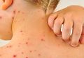 Penyakit Infeksi Rubella, Ini 7 Gejala Sebelum Ruam Muncul di Kulit