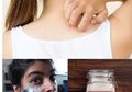 Berita Terpopuler: Baking Soda Diklaim Ampuh Atasi Gatal hingga Cara Menghilangkan Komedo Pakai Baking Soda