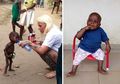 Hope, Bayi yang Dibuang dalam Keadaaan Mengenaskan Kini sudah Pulih