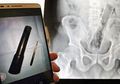 Pria Ini Menolak Memberi Tahu Dokter Bahwa Ada Benda Aneh Berbentuk Terompet di Anusnya