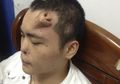 Hidung Lelaki Ini Terpaksa Diletakkan di Dahi