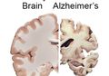Ingin Mencegah Penyakit Alzheimer? Ini Dia Cara Gampangnya
